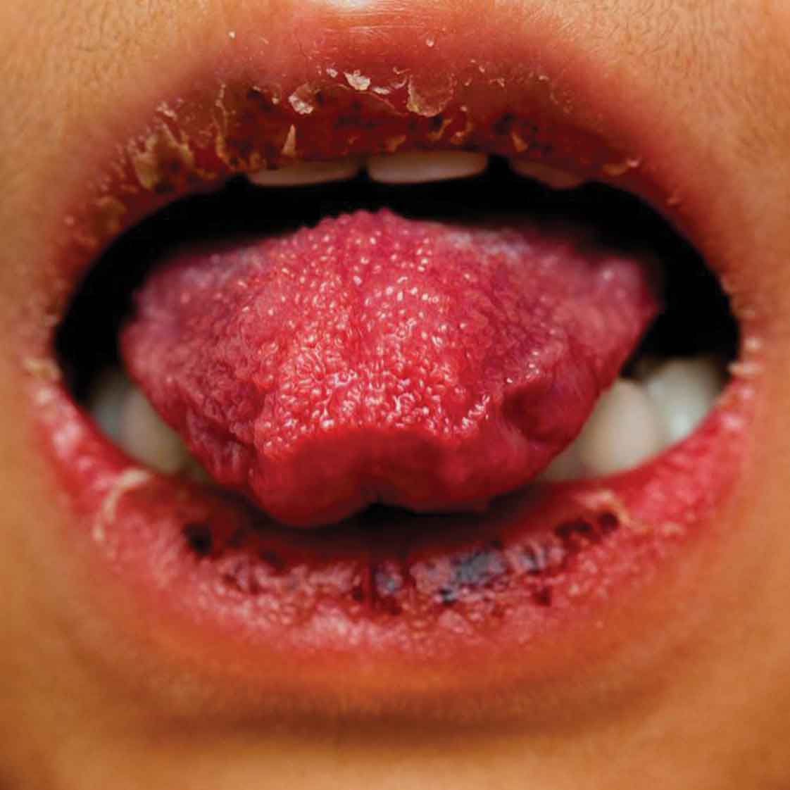Strawberry Tongue Pictures, Images & Photos | Photobucket